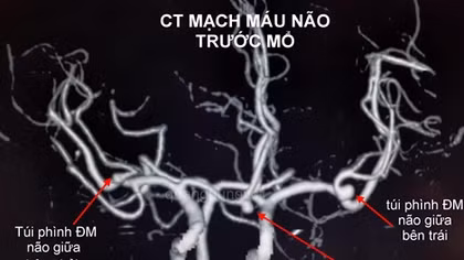 Bệnh nhân có 3 túi phình mạch máu não đã vỡ được cứu sống