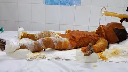 Bé gái 20 tháng tuổi bị bỏng nặng do đốt rác gây cháy nhà 