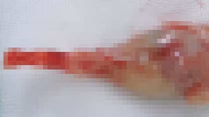 Thai nhi mắc hội chứng người cá vô cùng hiếm gặp