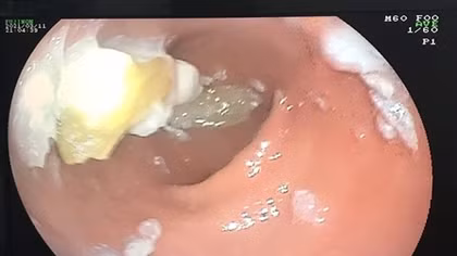 Nuốt 4 chiếc răng giả vào bụng trong lúc ăn cơm