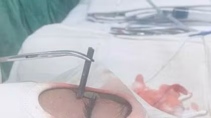 Cứu sống bệnh nhân bị đinh 3cm đâm vào mắt
