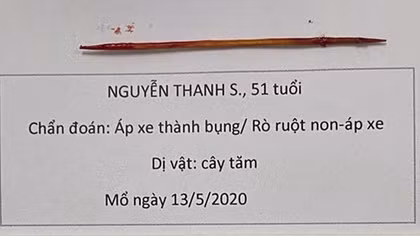 Tăm xỉa răng dài 6cm đâm thủng thành bụng 