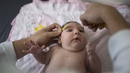 Trẻ mắc chứng đầu nhỏ do virus Zika đầu tiên ở Việt Nam