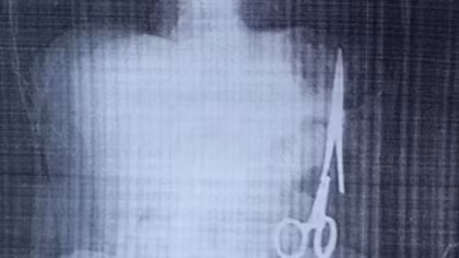 Xác minh vụ để quên panh trong bụng bệnh nhân 18 năm trước