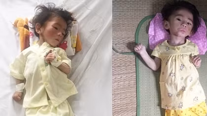 Cháu bé bị suy dinh dưỡng đã được ra viện
