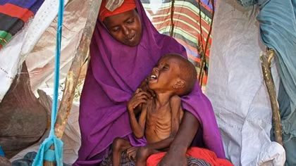 Đau xót 1,4 triệu trẻ em suy dinh dưỡng tại Somalia