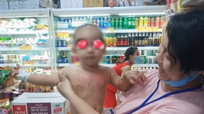Cấp cứu bé 2 tuổi bị bỏng từ nước sôi nấu mì gói