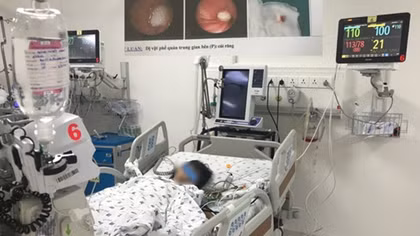 (Hy hữu) Nhổ răng sâu, răng văng vào phế quản phải đi cấp cứu