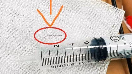 Bé nuốt phải dị vật từ rây lưới thép lẫn vào cháo