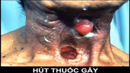 Hút thuốc lá, phá hủy đường hô hấp, rước bệnh ung thư