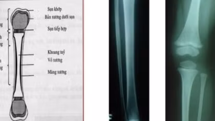 Giám định tuổi người sống để làm rõ nghi án