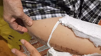  Viện KHHS (Bộ Công an): Giám định thương tích học sinh bị gãy chân