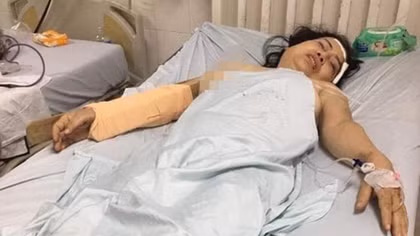  Cầm cây đánh nhiều nhát vào đầu người vợ cũ