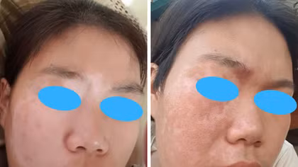 Ghép tế bào thượng bì tự thân không qua nuôi cấy điều trị bạch biến