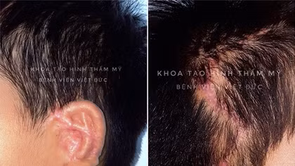BV Việt Đức phẫu thuật tạo hình thành công tai nhỏ microtia tiên tiến nhất thế giới