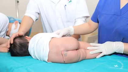 Cắt đuôi bẩm sinh hiếm gặp cho bé gái 5 tháng tuổi