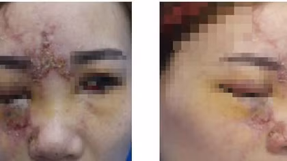 Thêm một cô gái có nguy cơ mù mắt do tiêm filler nâng mũi