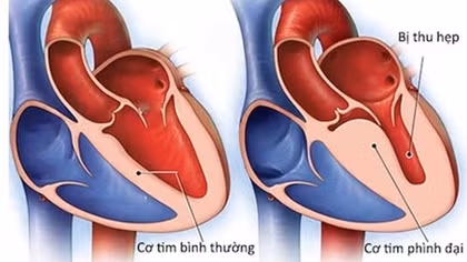 Chuyên gia khẳng định: Thông tin "virus lạ" gây viêm cơ tim là không có cơ sở