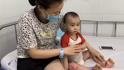 4 người tử vong vì tay chân miệng