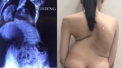  Bệnh viện Bạch Mai khám miễn phí cong vẹo cột sống cho trẻ em