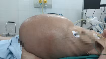 Mổ lấy khối u buồng trứng gần 30kg trong bụng cụ bà 78 tuổi