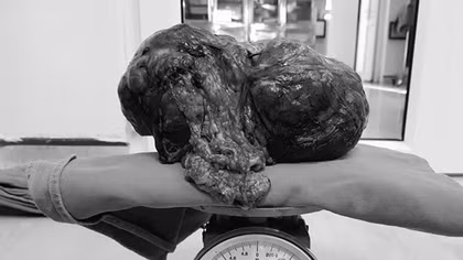 Phẫu thuật bóc khối u mạc treo ruột khổng lồ 3,5kg từ bụng người đàn ông