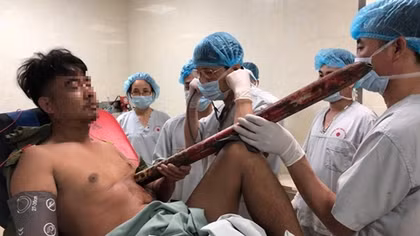 Nam thanh niên bị thanh sắt dài 2m đâm thấu ngực