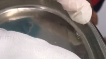 Con vắt dài 3cm sống 1 tháng trong mũi bé trai