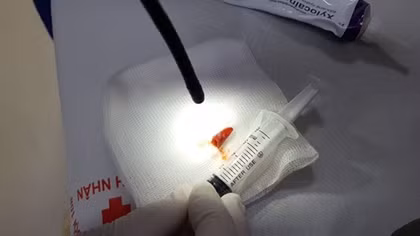 Mảnh ớt nằm trong phế quản 2 tháng suýt nhầm thành ung thư phổi