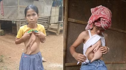 Kỳ lạ bé gái có “chị em sinh đôi” ngay trước ngực