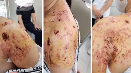 Bó lá điều trị gãy xương đòn, người phụ nữ ở Hà Nội bị bỏng da và nhiễm trùng nặng