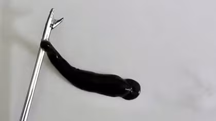 Đỉa suối 4cm nằm trong mũi một thiếu niên