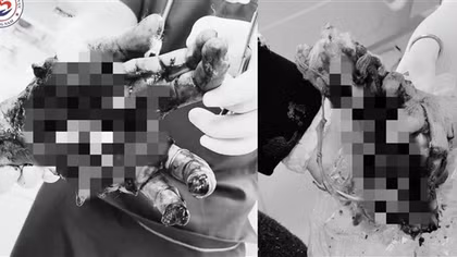 Kịp thời cứu chữa nam thanh niên bị dập nát 2 tay nghi do pháo nổ tự chế