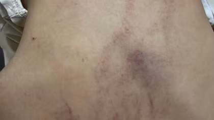 Đình chỉ thêm một giáo viên vụ bạo hành bé gái 4 tuổi