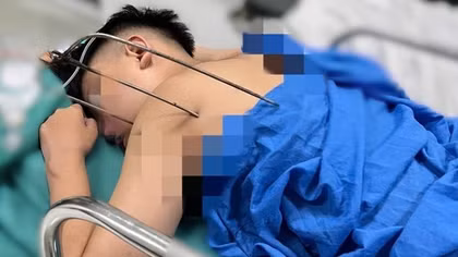 Cứu sống thiếu niên bị đinh ba đâm vào tim nguy kịch