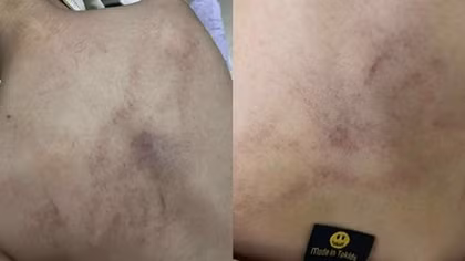Hà Nội: Tạm đình chỉ giáo viên mầm non bạo hành bé gái