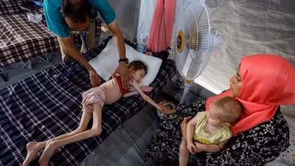 Xót xa những đứa trẻ suy dinh dưỡng giữa vùng chiến Gaza