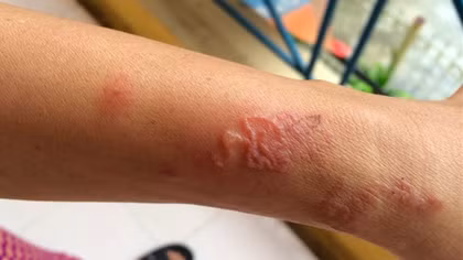 Cụ ông nguy kịch vì nhiễm giun lươn lan toả