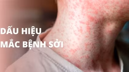 Nhiều người lớn sốt cao nhưng không biết bị mắc sởi nặng