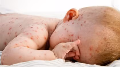 Ghi nhận 42 ca mắc bệnh sởi, Bộ Y tế đề nghị đẩy mạnh tiêm chủng