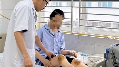 Dùng ong đốt vào đầu gối chữa bệnh, người phụ nữ bị hoại tử cẳng chân