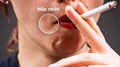 Hút thuốc lá làm tăng quá trình lão hoá, sớm xuất hiện các nếp nhăn