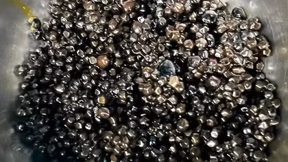 Cụ bà 73 tuổi có hàng nghìn viên sỏi mật