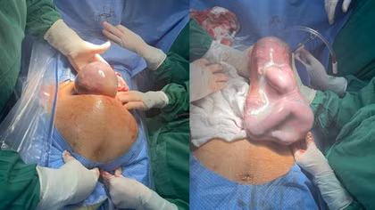 Bé gái chào đời trong “bọc điều” hiếm gặp