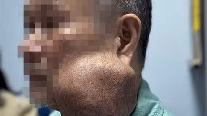 Suýt mất mạng vì mang khối u khổng lồ 30 năm không điều trị