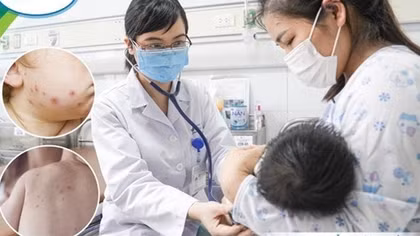 Trẻ sơ sinh bị thuỷ đậu biến chứng viêm phổi, suy hô hấp, cha mẹ không được chủ quan