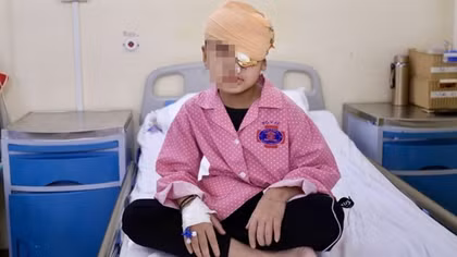 Phẫu thuật cho bé 4 tuổi có u "quái" hốc mắt chiếm gần nửa khuôn mặt