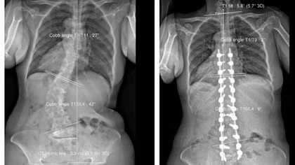 Trả lại 8cm chiều cao cho bệnh nhân sau ca mổ kéo dài hơn 7 giờ đồng hồ