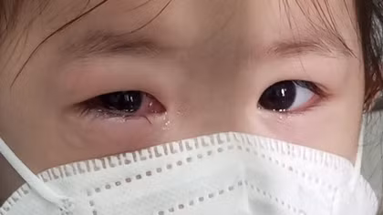 Bệnh đau mắt đỏ bùng phát mạnh, bác sĩ hướng dẫn cách điều trị
