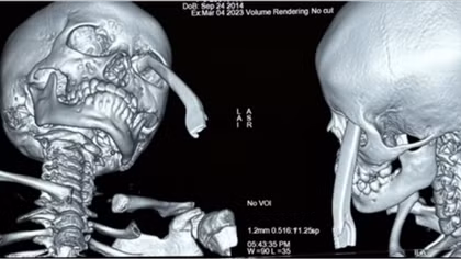 Hai bệnh viện “báo động đỏ” cấp cứu trẻ bị tay thắng xe đâm vào hốc mắt